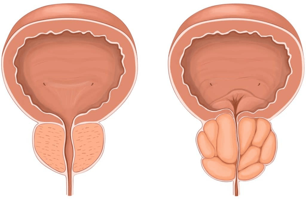 Zer gertatzen zaio prostatari prostatitisaren garaian