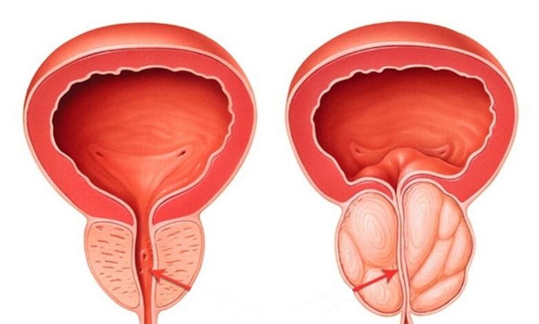 Prostatitis osasuntsua eta hantura